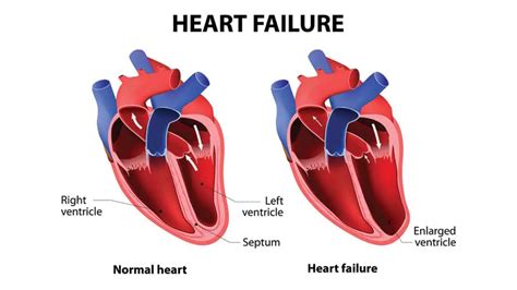 left ventricular systolic heart failure prognosis.